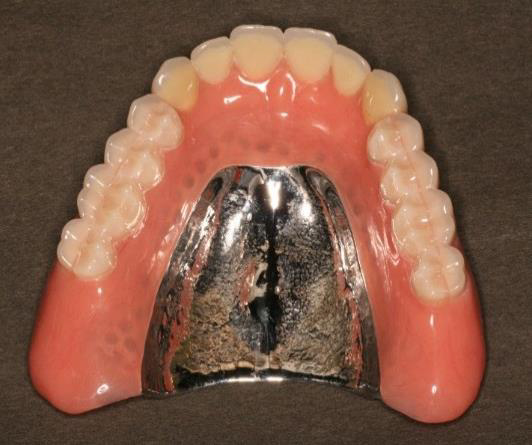 保険と自費の入れ歯はなにが違うの