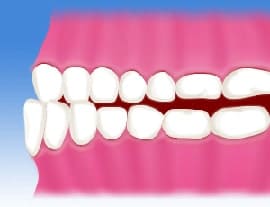 下顎前突（受け口、反対咬合）
