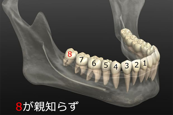 親知らずの抜歯